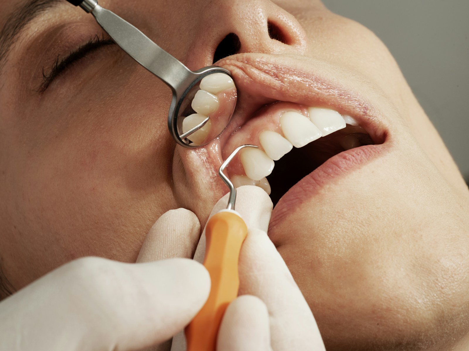 Anterior dişlerde klinik muayene ve marjin kontrolü