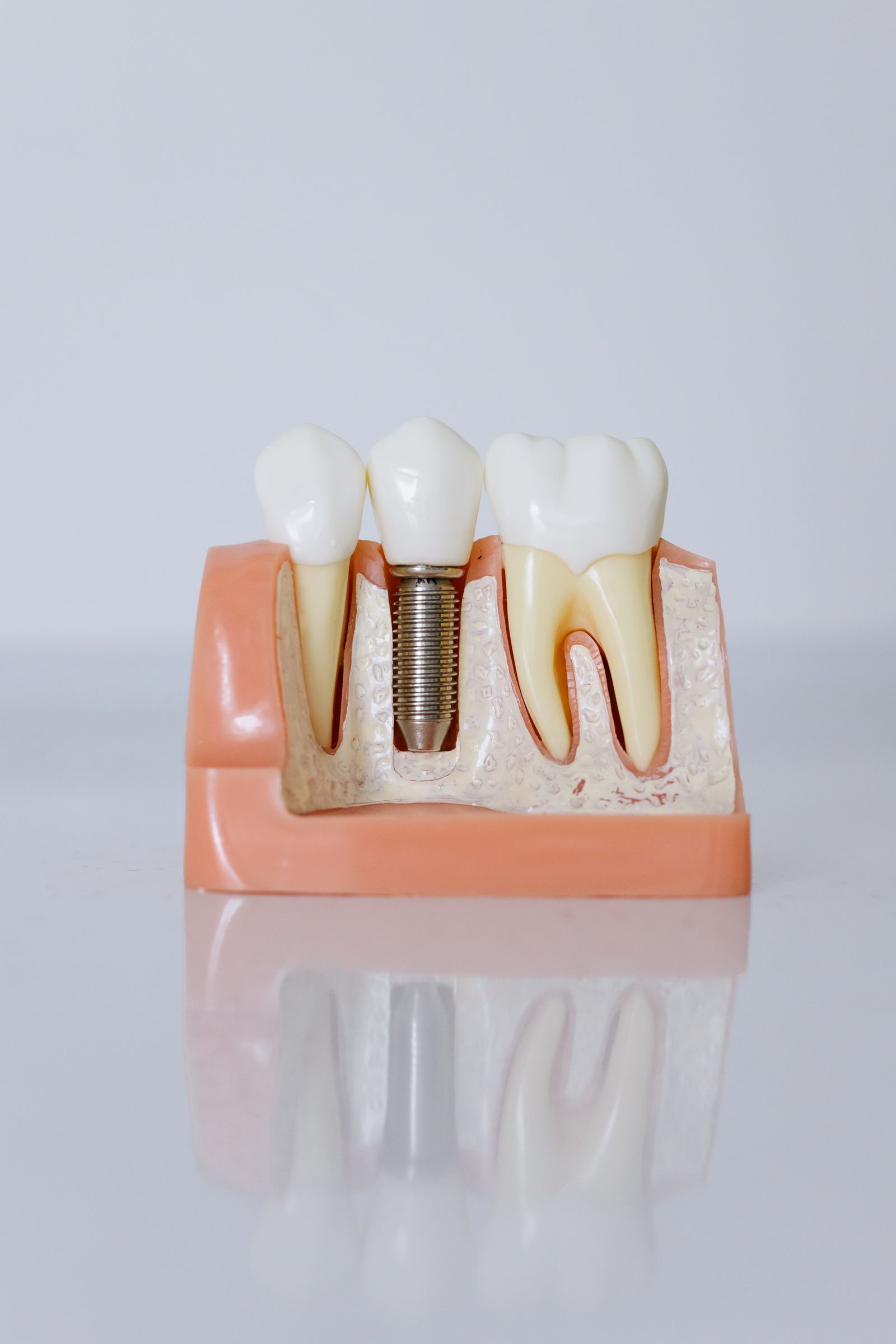 Ti-base implant modeli: vida, abutment ve kron kesiti
