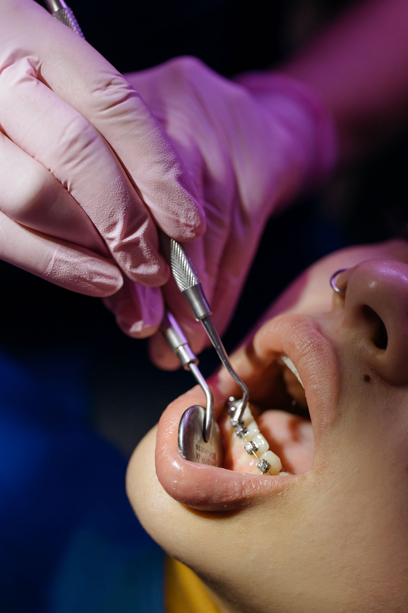 Ortodontik braket ve klinik uygulama